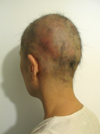 全頭型円形脱毛症 1年6ヶ月経過 写真