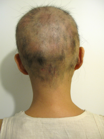 全頭型円形脱毛症 1年6ヶ月経過 写真