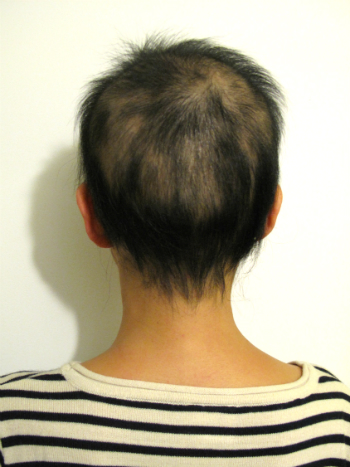 全頭型円形脱毛症 1年 9ヶ月経過 写真